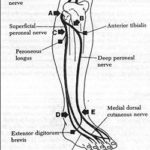 Peroneal sinir tuzaklanması ve Tedavisi