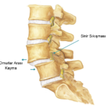 Bel Kayması ve Osteopatik Tedavisi