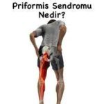 Piriformis Sendromu ve Tedavisi