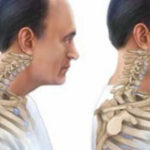 Boyun Düzleşmesi ve Osteopatik Tedavisi
