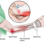 Lateral Epikondilit (Tenisçi Dirseği) Tedavisi