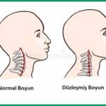 Ameliyatsız Boyun Düzleşmesi Tedavisi