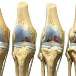 Kireçlenme (Osteoartrit)