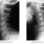 Boyun Düzleşmesinde Fizik Tedavi