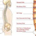 Bel ve Boyun Fıtığı Ameliyatı Sonrası Tedavi