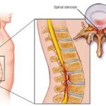 Ameliyatsız Kanal Darlığı (Spinal Stenoz) Tedavisi